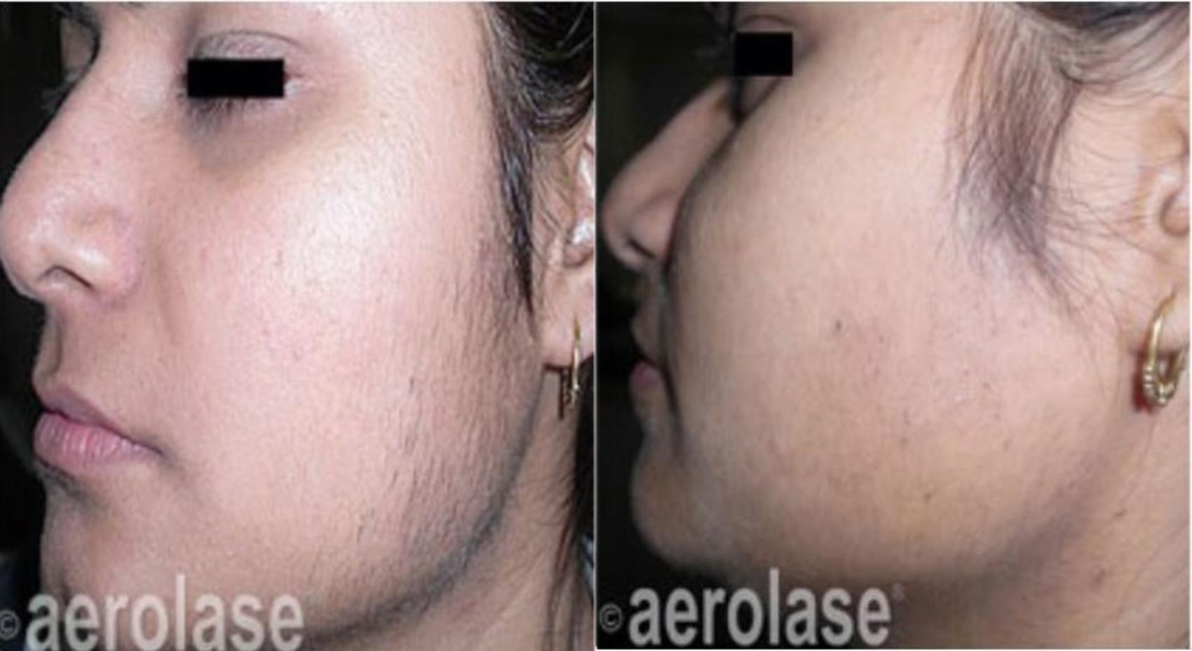 Before & After Laser Hair Removal Case 321 View #1 View in Houston, TX