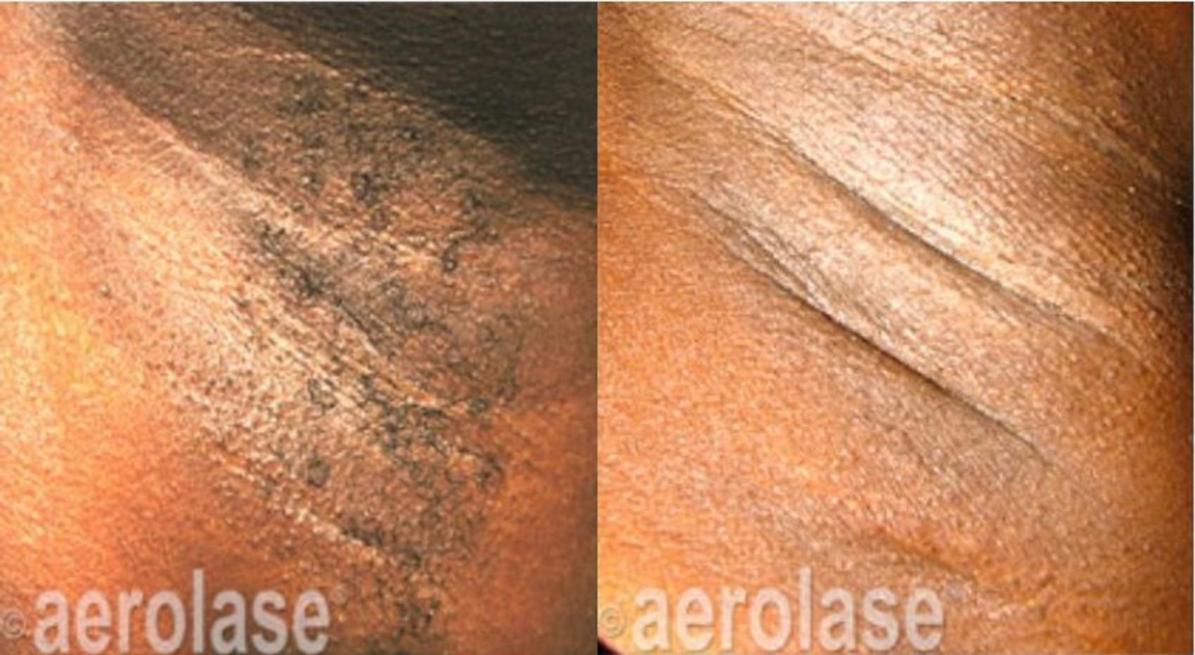 Before & After Laser Hair Removal Case 322 View #1 View in Houston, TX