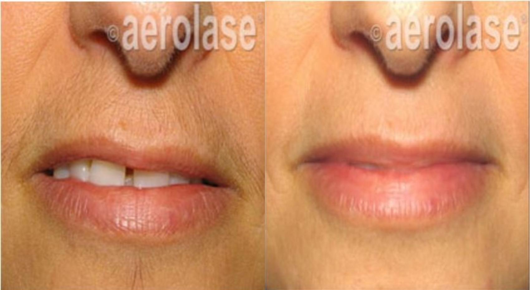 Before & After Laser Hair Removal Case 323 View #1 View in Houston, TX