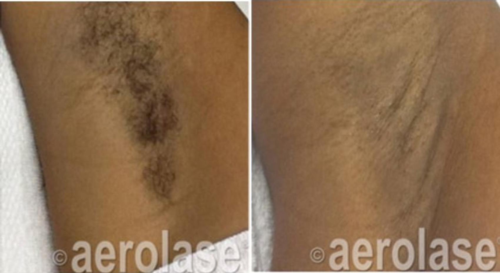 Before & After Laser Hair Removal Case 324 View #1 View in Houston, TX