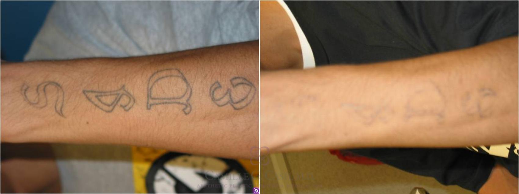 Before & After Laser Tattoo Removal Case 36 View #1 View in Houston, TX