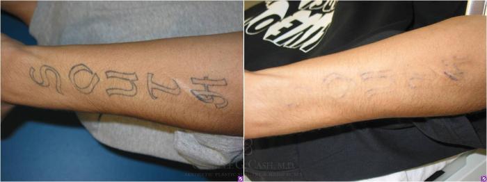 Before & After Laser Tattoo Removal Case 36 View #2 View in Houston, TX