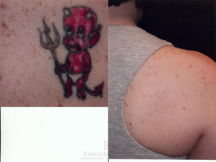 Before & After Laser Tattoo Removal Case 44 View #1 View in Houston, TX