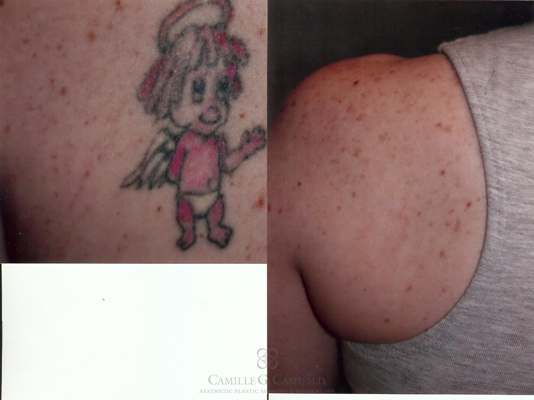 Before & After Laser Tattoo Removal Case 44 View #2 View in Houston, TX