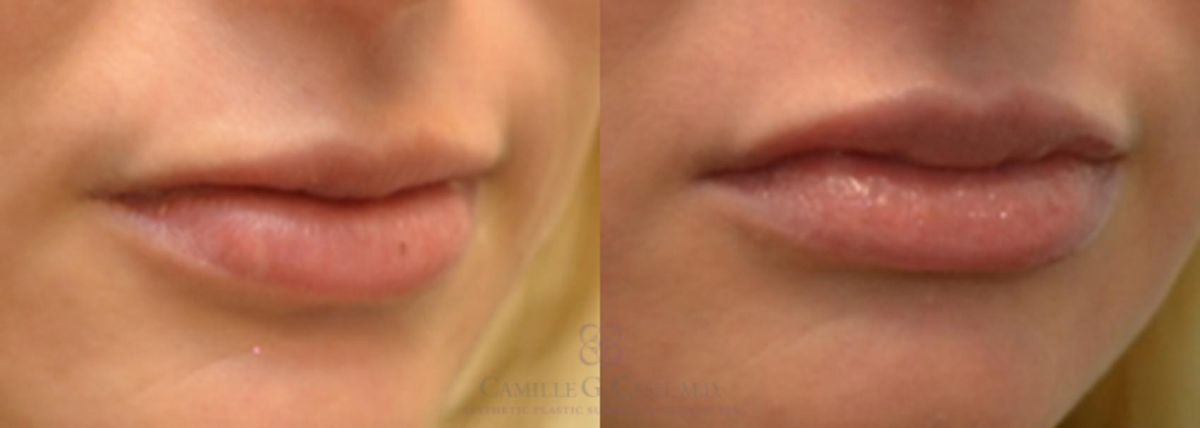 Before & After Lip Augmentation Case 131 View #1 View in Houston, TX