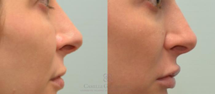 Before & After Lip Augmentation Case 131 View #2 View in Houston, TX