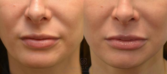 Before & After Lip Augmentation Case 131 View #3 View in Houston, TX