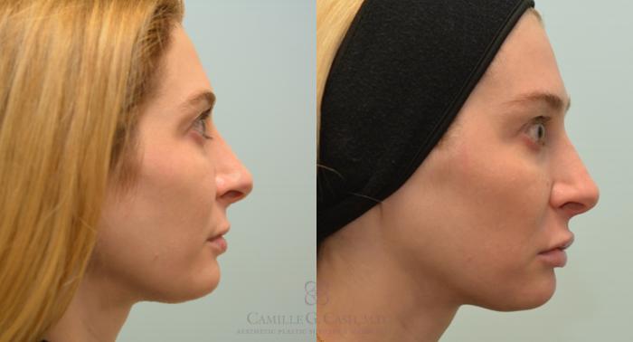 Before & After Lip Augmentation Case 131 View #4 View in Houston, TX