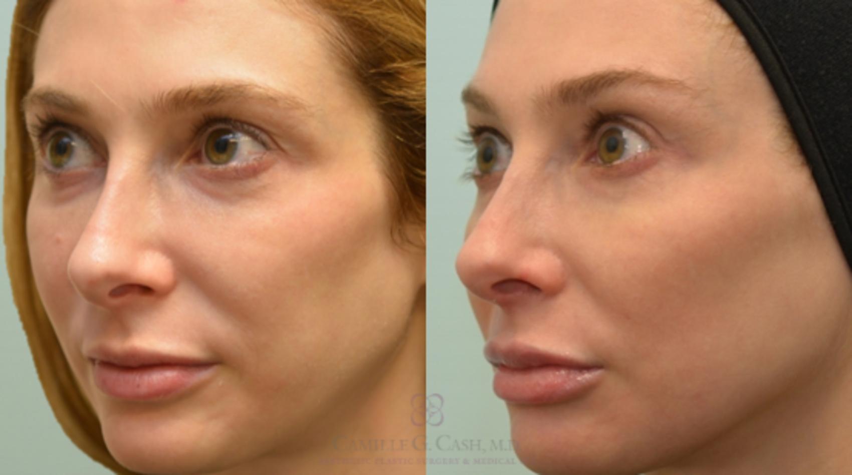 Before & After Lip Augmentation Case 131 View #5 View in Houston, TX
