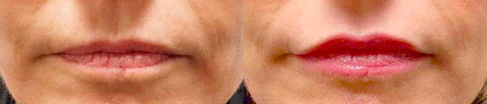 Before & After Lip Augmentation Case 191 View #1 View in Houston, TX