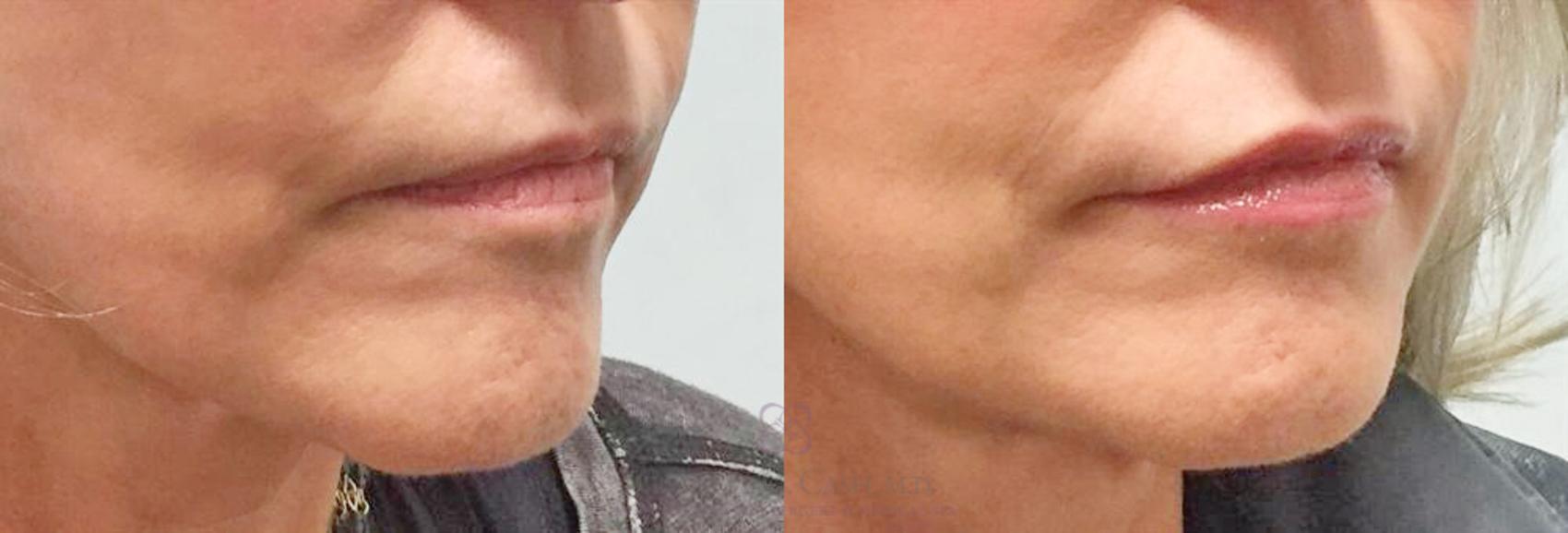 Before & After Lip Augmentation Case 191 View #2 View in Houston, TX