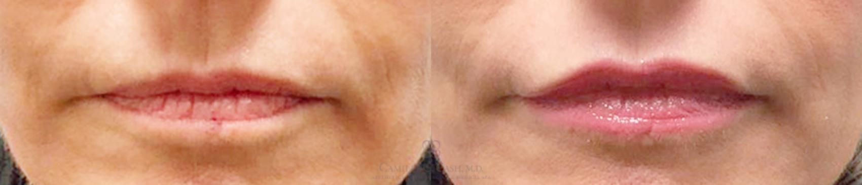 Before & After Lip Augmentation Case 191 View #3 View in Houston, TX