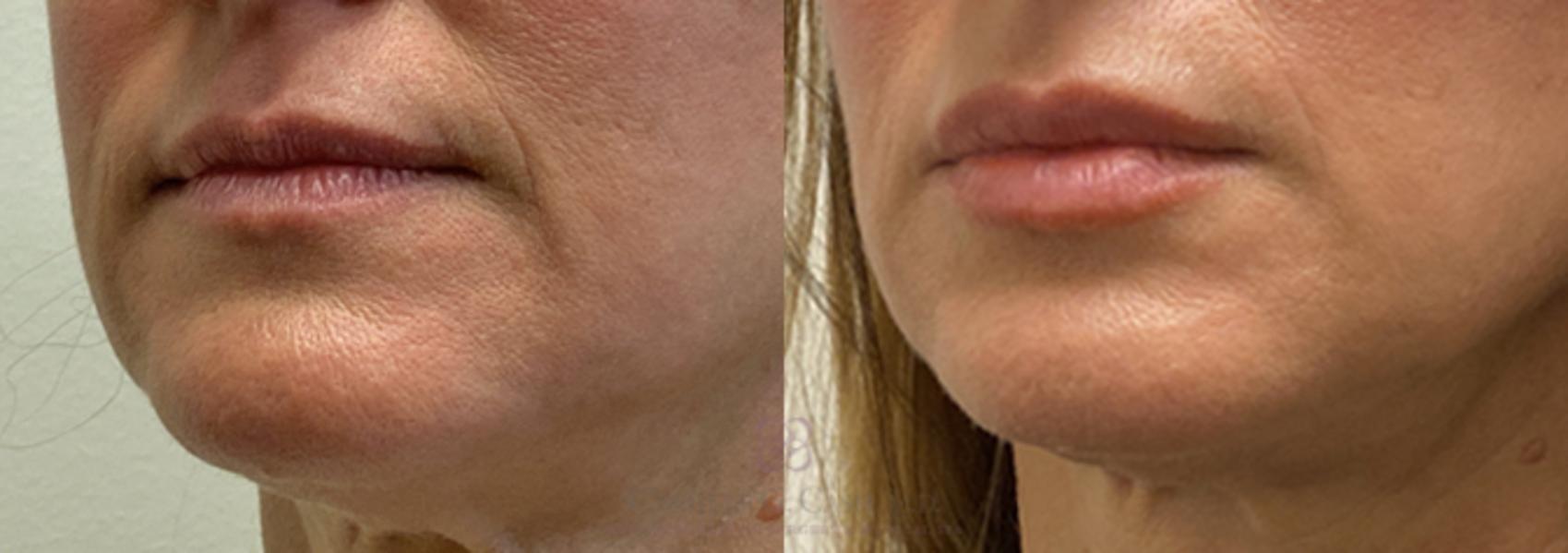 Before & After Lip Augmentation Case 383 View #2 View in Houston, TX
