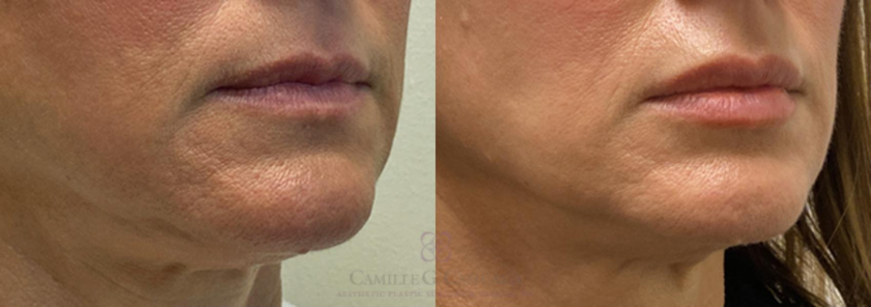 Before & After Lip Augmentation Case 383 View #3 View in Houston, TX
