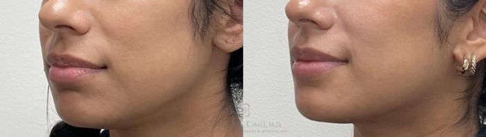 Before & After Lip Augmentation Case 653 Left Oblique View in Houston, TX