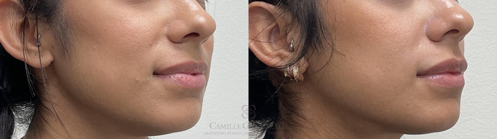 Before & After Lip Augmentation Case 653 Right Oblique View in Houston, TX