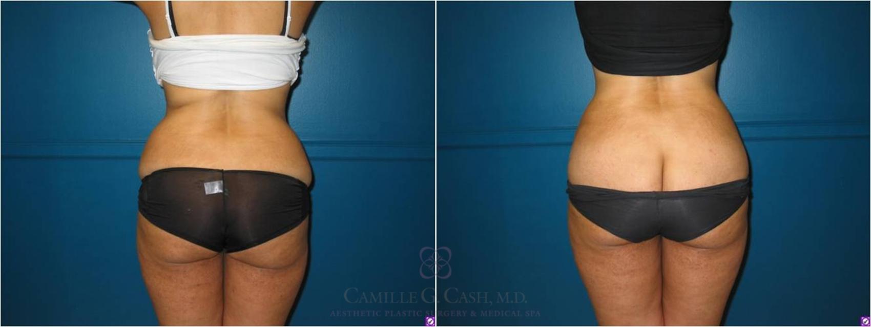 Before & After Lipodissolve Case 21 View #1 View in Houston, TX