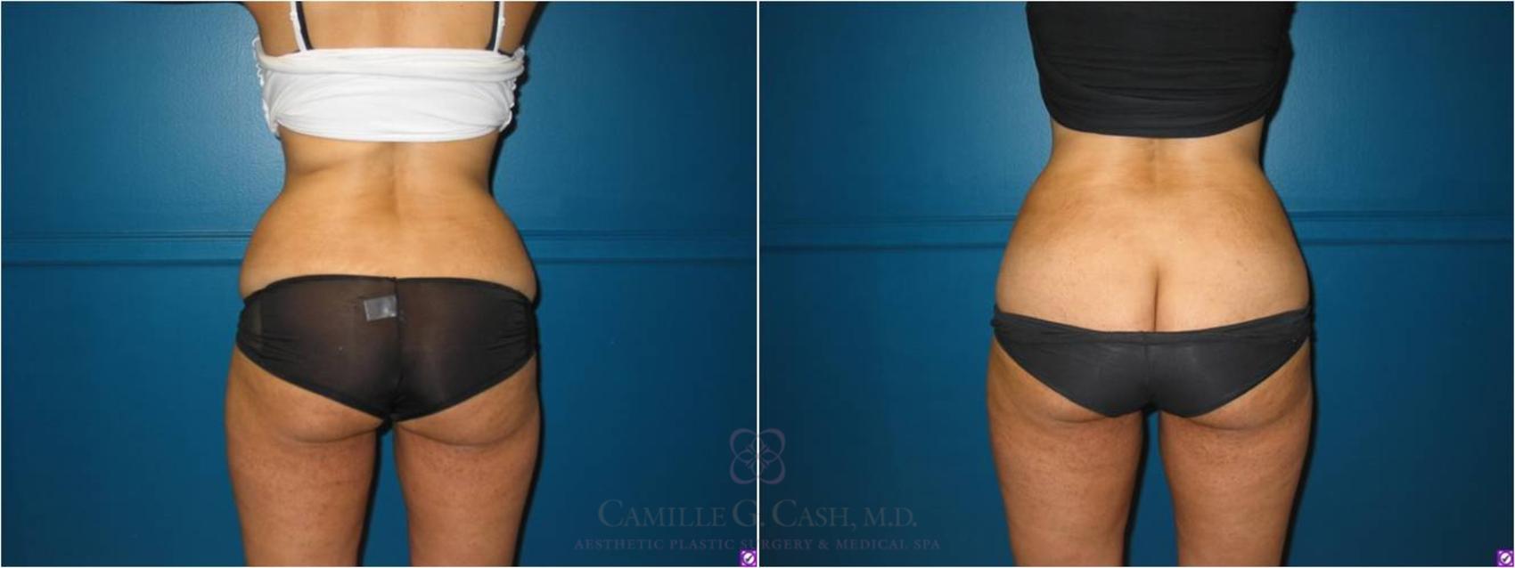 Before & After Lipodissolve Case 21 View #2 View in Houston, TX