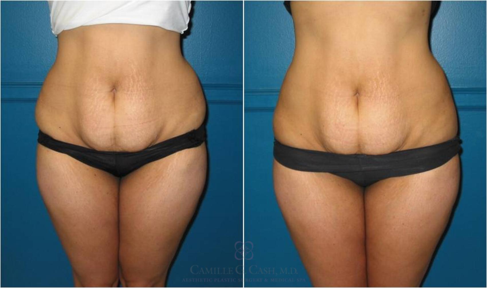 Before & After Lipodissolve Case 21 View #3 View in Houston, TX