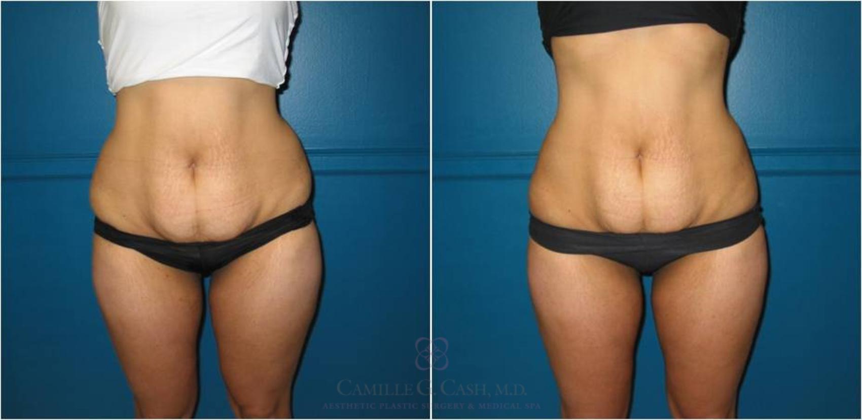 Before & After Lipodissolve Case 21 View #4 View in Houston, TX