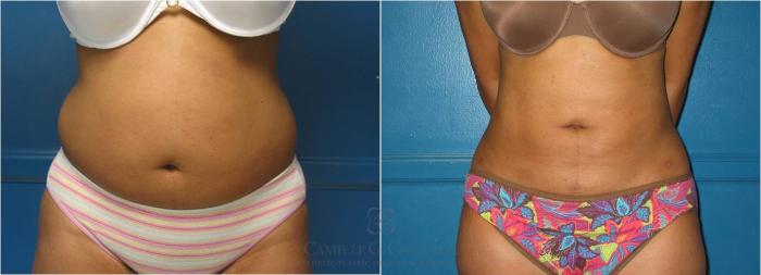 Before & After Liposuction Case 18 View #1 View in Houston, TX