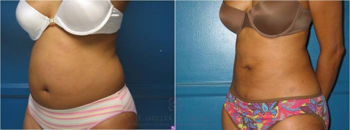 Before & After Liposuction Case 18 View #2 View in Houston, TX
