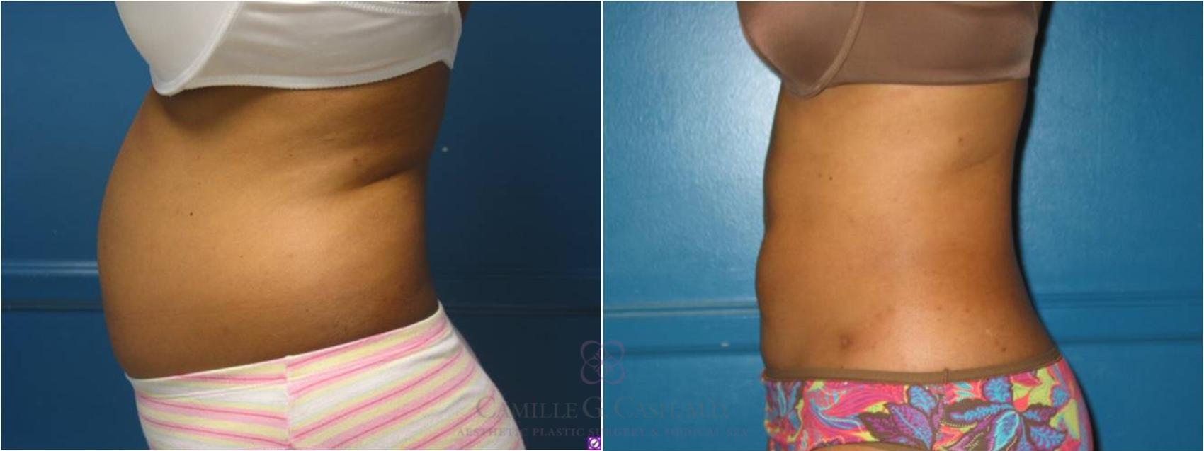 Before & After Liposuction Case 18 View #3 View in Houston, TX