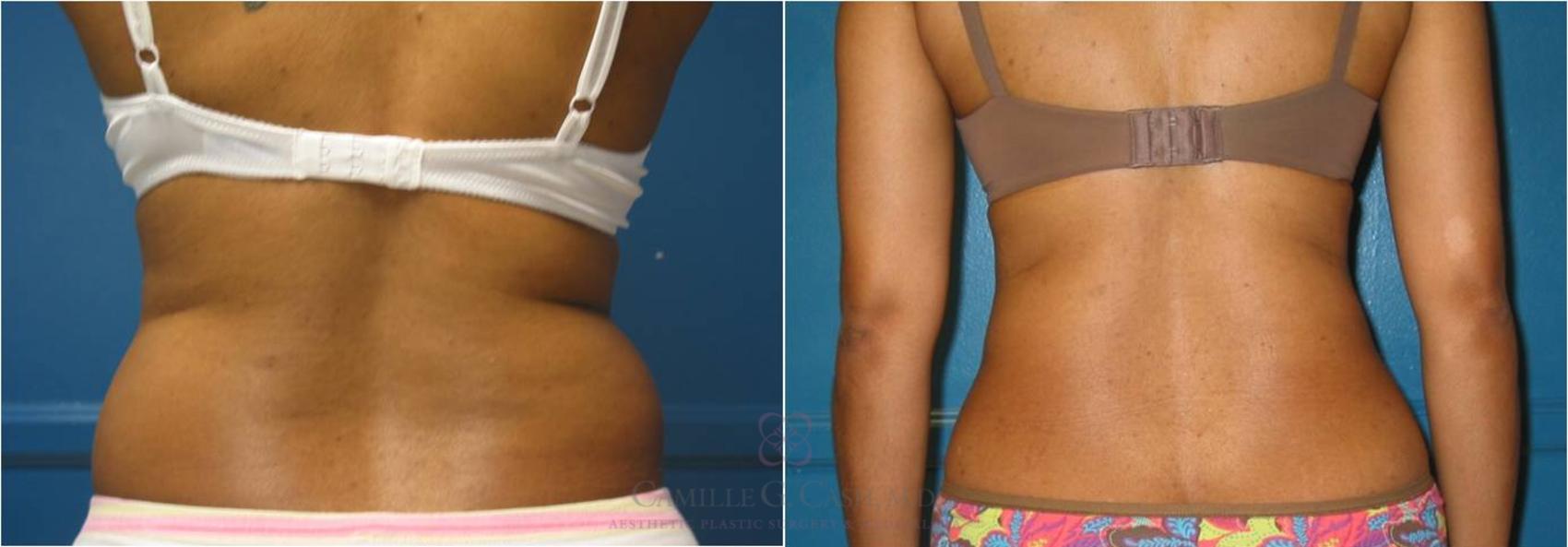 Before & After Liposuction Case 18 View #4 View in Houston, TX