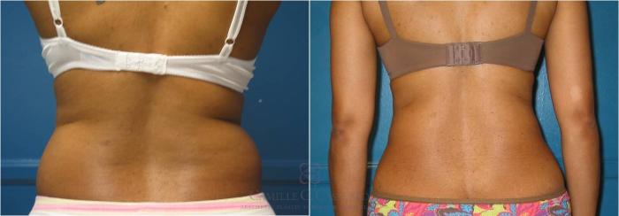 Before & After Liposuction Case 18 View #4 View in Houston, TX