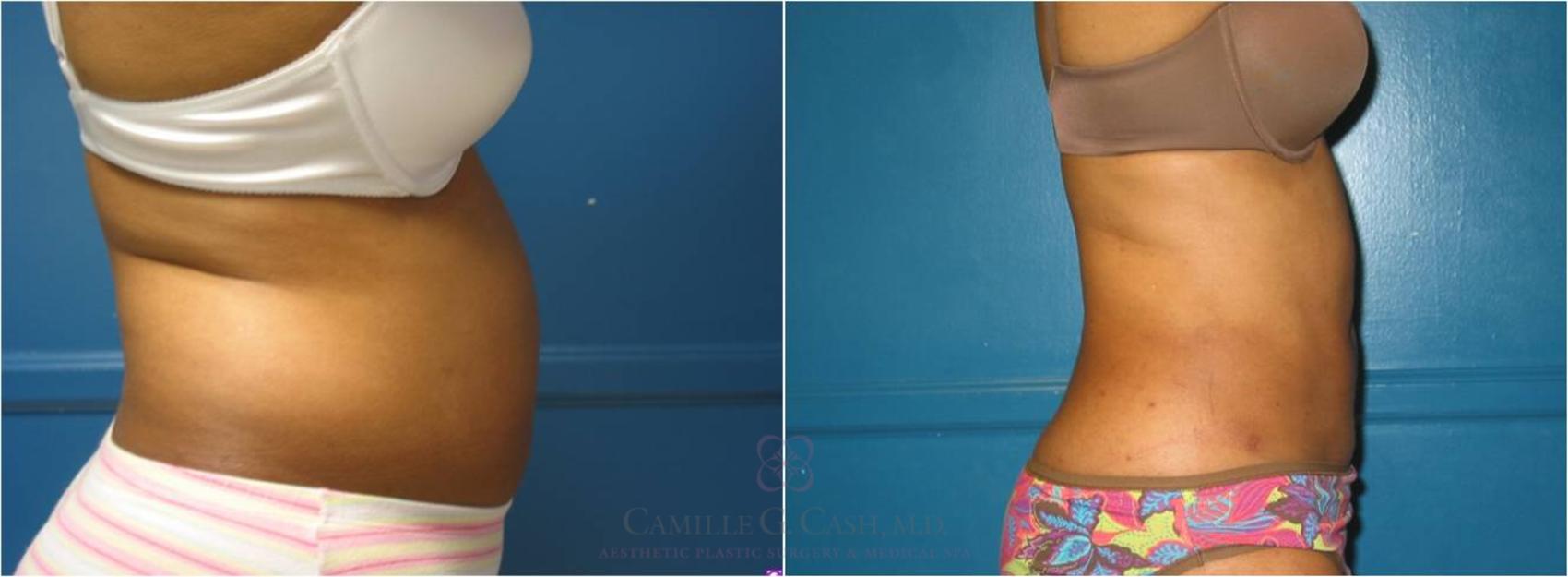 Before & After Liposuction Case 18 View #5 View in Houston, TX