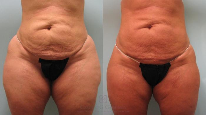 Before & After Liposuction Case 189 View #1 View in Houston, TX