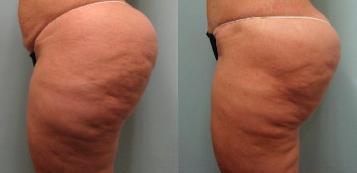 Before & After Liposuction Case 189 View #2 View in Houston, TX