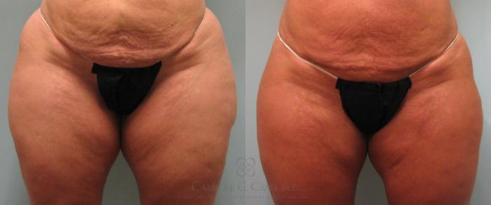 Before & After Liposuction Case 189 View #3 View in Houston, TX