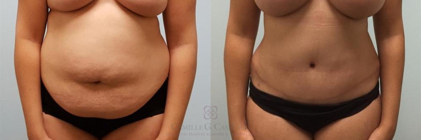 Before & After Liposuction Case 249 View #1 View in Houston, TX