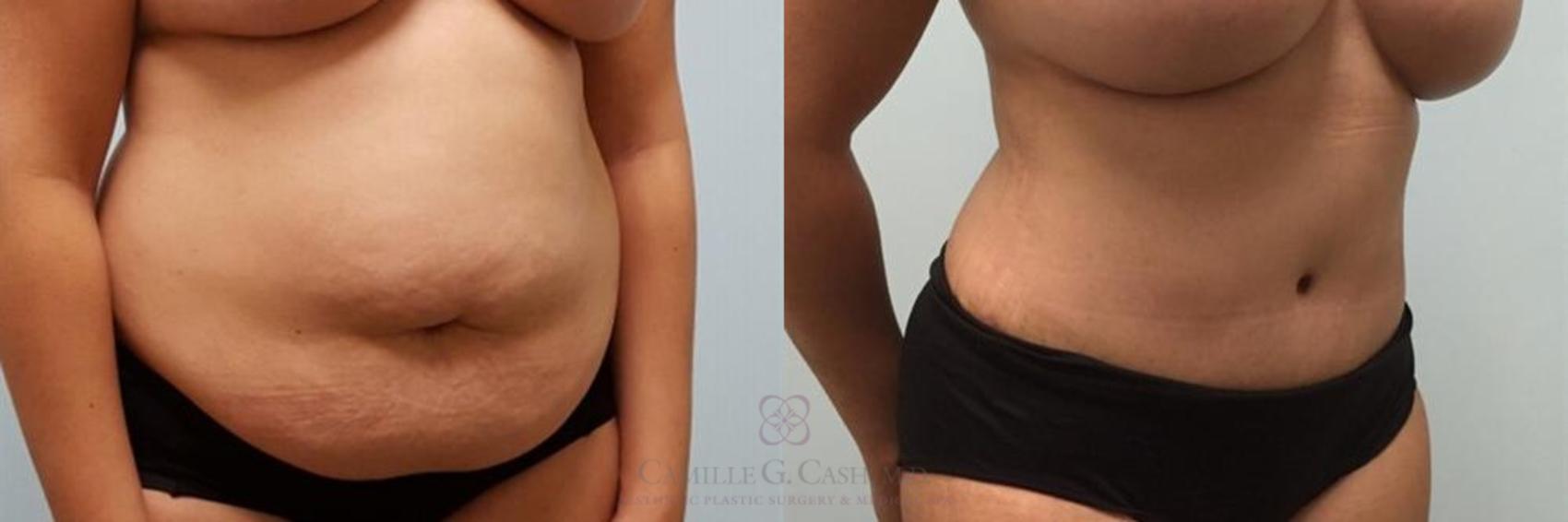 Before & After Liposuction Case 249 View #3 View in Houston, TX