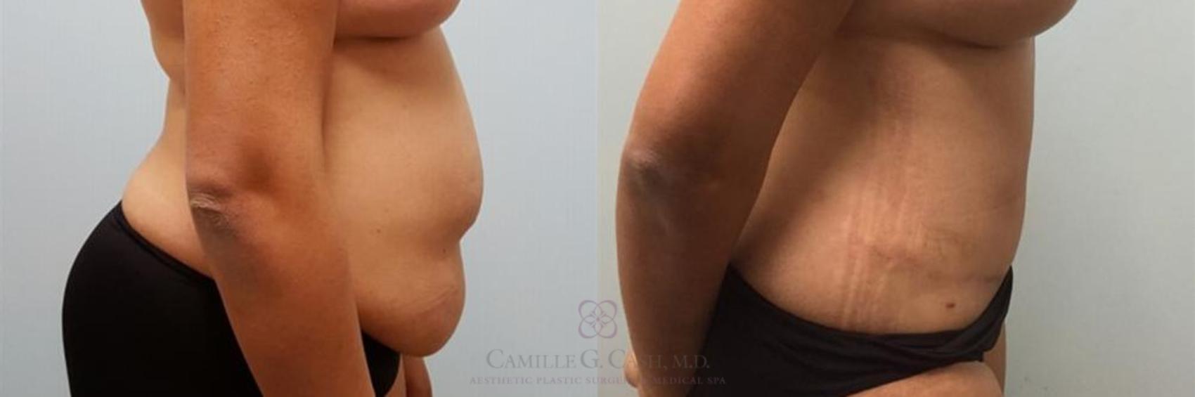 Before & After Liposuction Case 249 View #4 View in Houston, TX