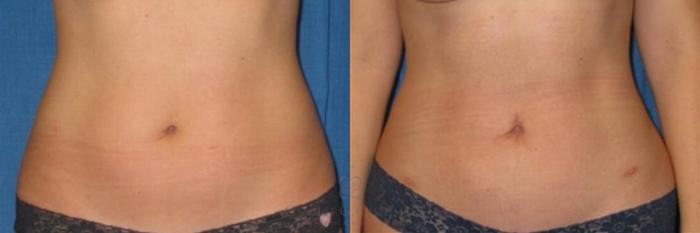 Before & After Liposuction Case 259 View #1 View in Houston, TX