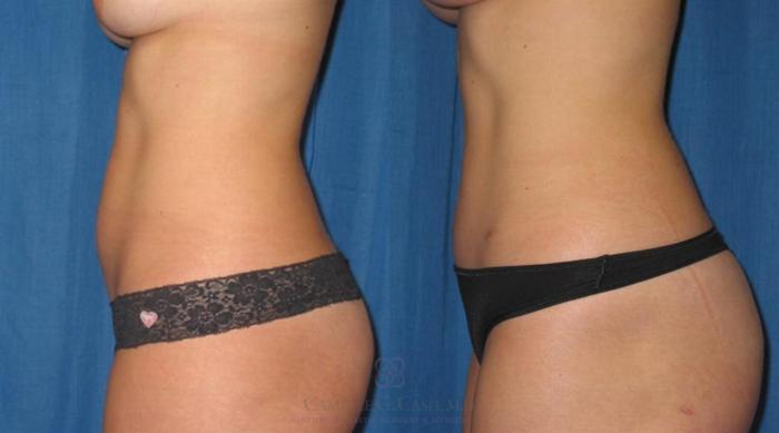 Before & After Liposuction Case 259 View #2 View in Houston, TX