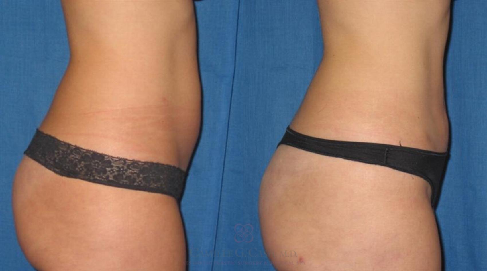 Before & After Liposuction Case 259 View #3 View in Houston, TX