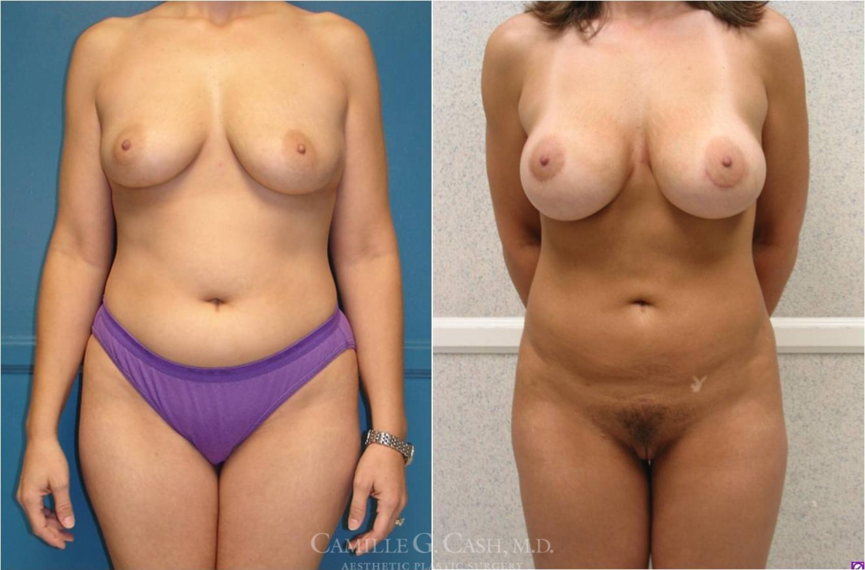 Before & After Liposuction Case 26 View #1 View in Houston, TX