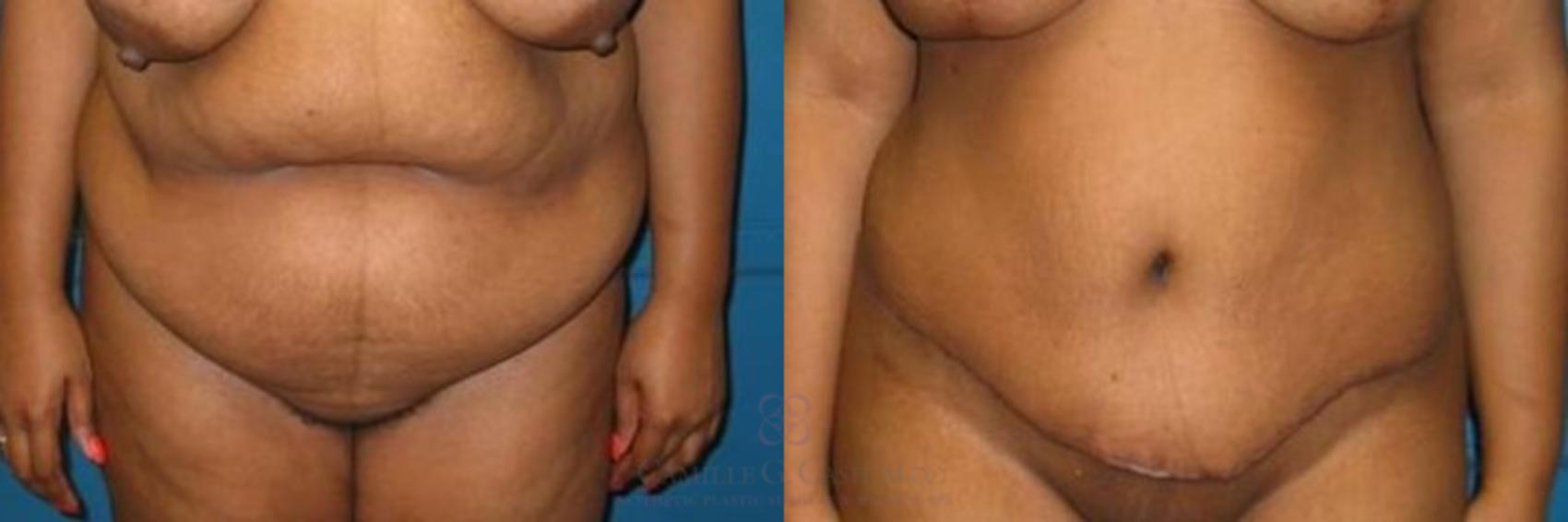 Before & After Liposuction Case 262 View #1 View in Houston, TX