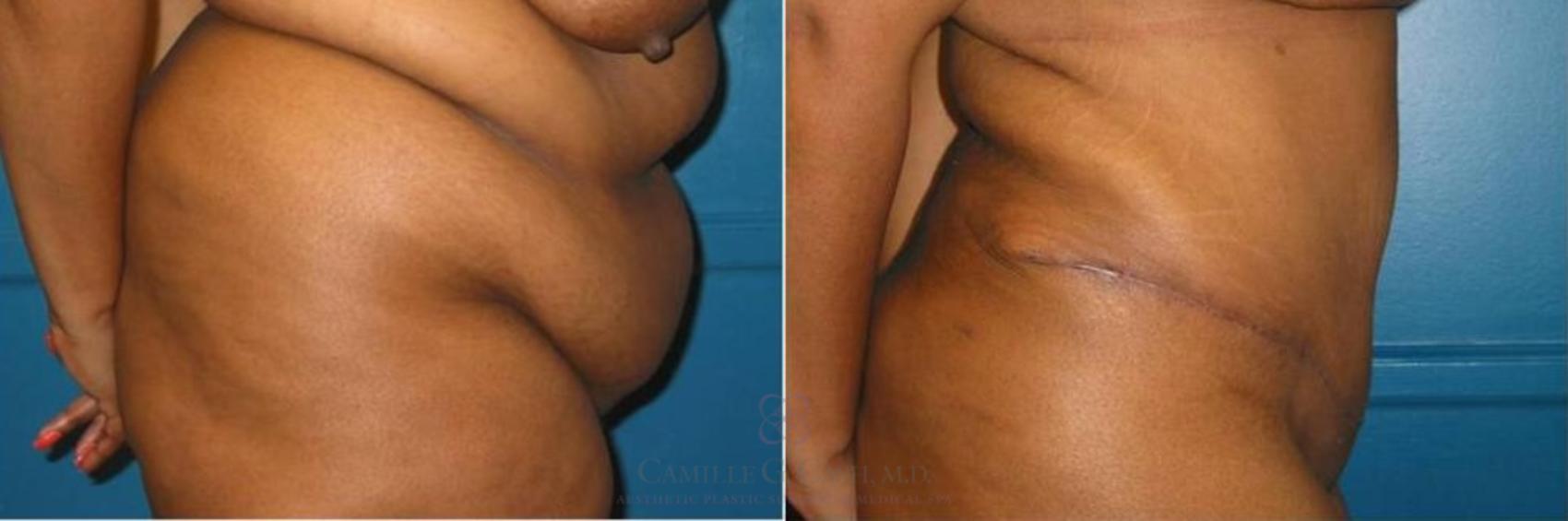 Before & After Liposuction Case 262 View #2 View in Houston, TX
