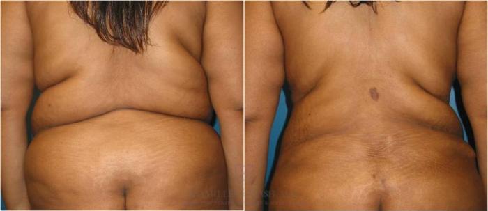Before & After Liposuction Case 262 View #3 View in Houston, TX