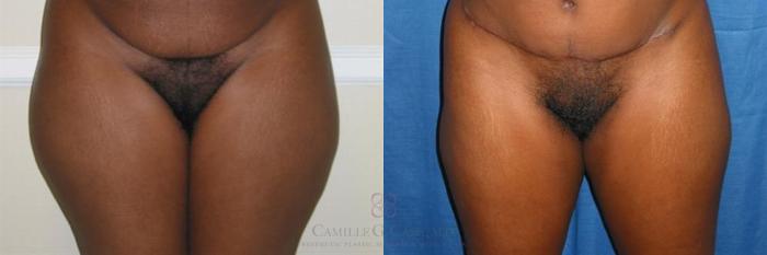 Before & After Liposuction Case 280 View #1 View in Houston, TX