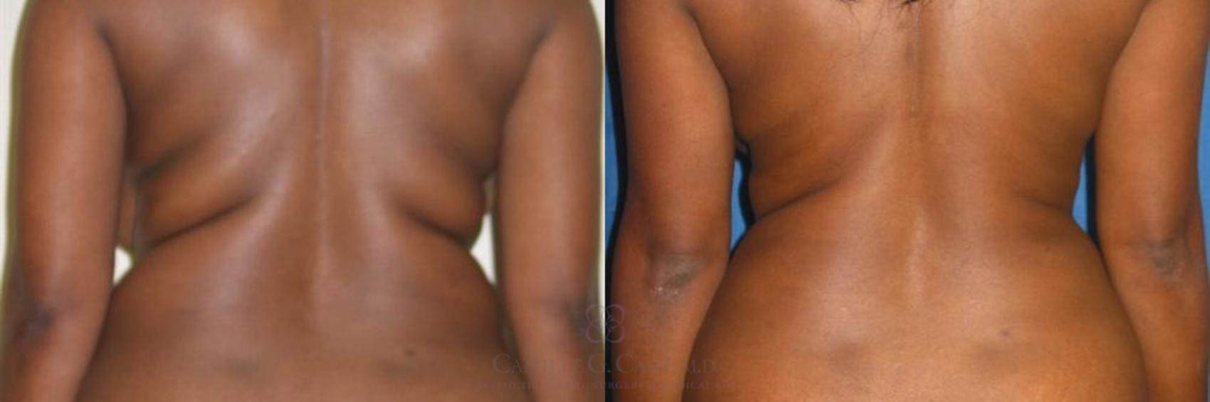 Before & After Liposuction Case 280 View #2 View in Houston, TX