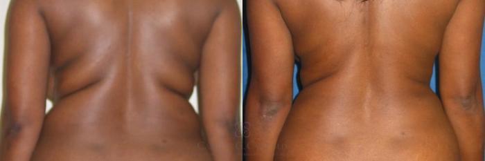 Before & After Liposuction Case 280 View #2 View in Houston, TX