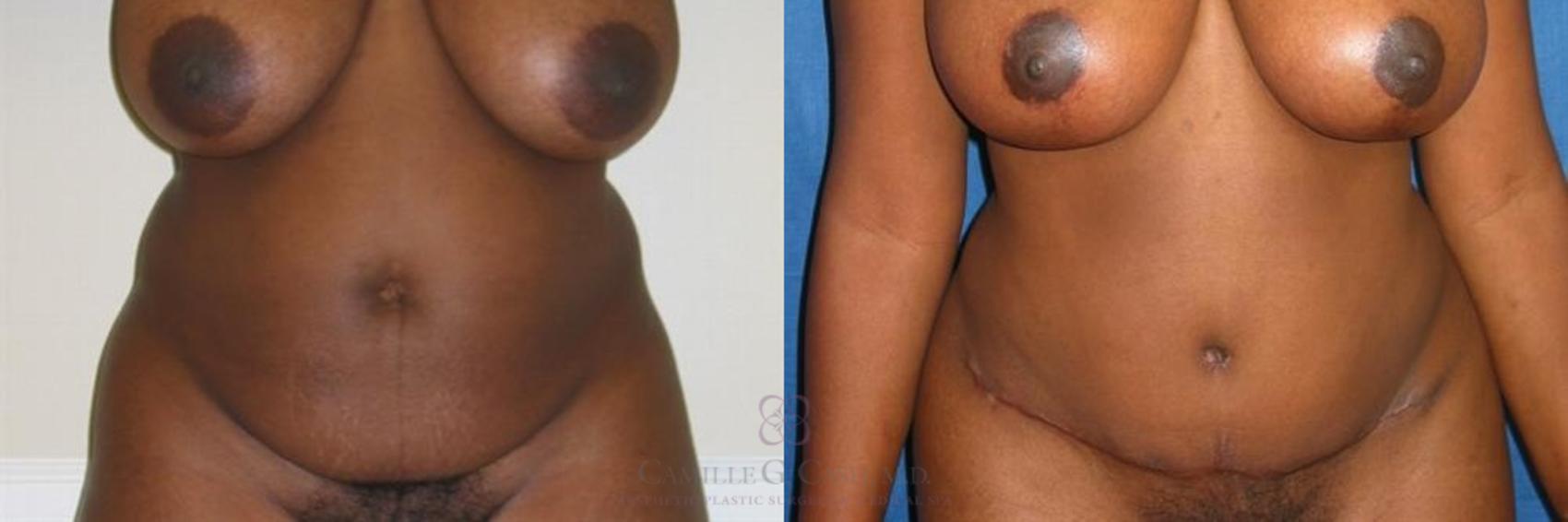 Before & After Liposuction Case 280 View #3 View in Houston, TX