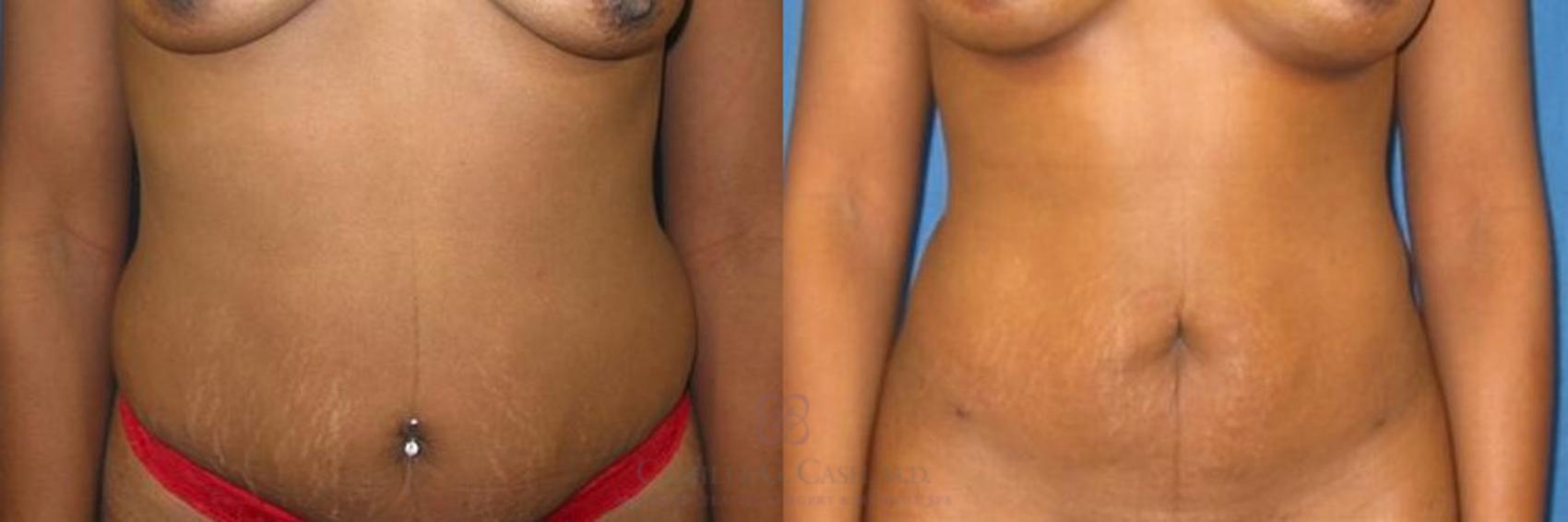 Before & After Liposuction Case 283 View #1 View in Houston, TX