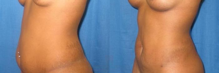 Before & After Liposuction Case 283 View #2 View in Houston, TX