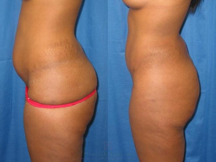 Before & After Liposuction Case 283 View #3 View in Houston, TX
